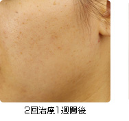 2回治療1週間後