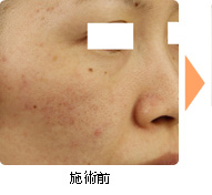 施術前