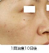 1回治療10日後