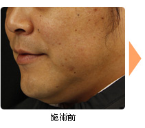施術前