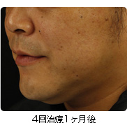 4回治療1ヶ月後