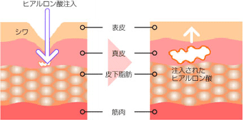 ヒアルロン酸注入の説明図