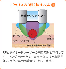 ポラリスWR照射のしくみ