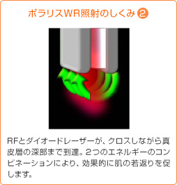 ポラリスWR照射のしくみ
