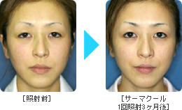 サーマクールBefore & After Face1