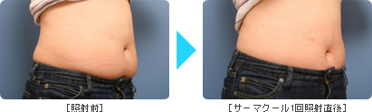 サーマクールBefore & After Body1