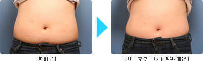 サーマクールBefore & After Body2