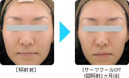 サーマクールBefore & After Face1