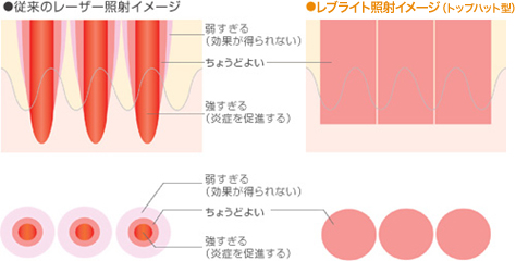 ポイント①「レーザーが照射される形」のイメージ