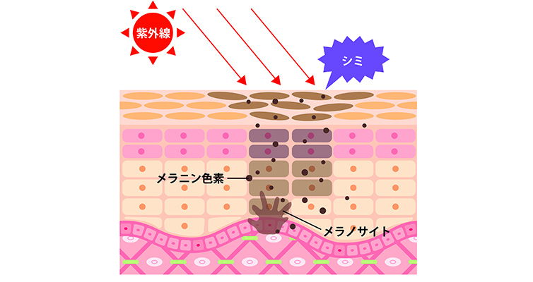 しみの原因は紫外線？ しみができるまでのメカニズム